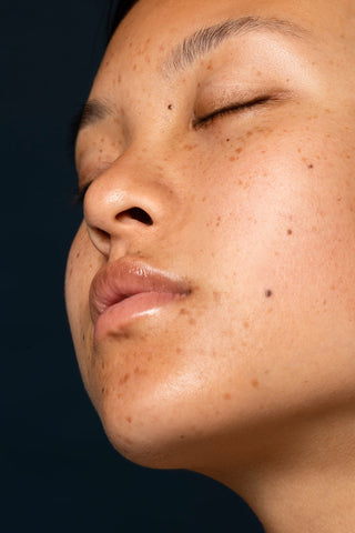 Hyperpigmented Skin
