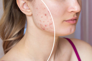 Blemish & Acne Prone