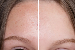 Enlarged Pores