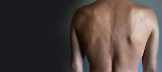 A person's back showing signs of acne, suitable for showcasing before and after results of a acne treatment.