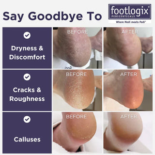 Footlogix Ultimate "At Home" Foot Care Combo (100ml)