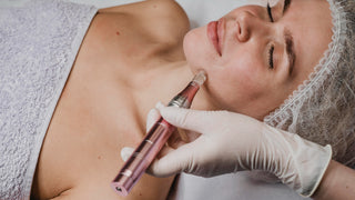 A person receiving a microneedle mesotherapy treatment on their face by a professional.
