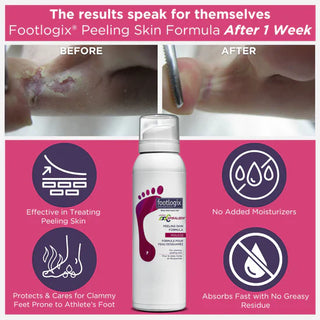 Footlogix Peeling Skin Formula (125ml)