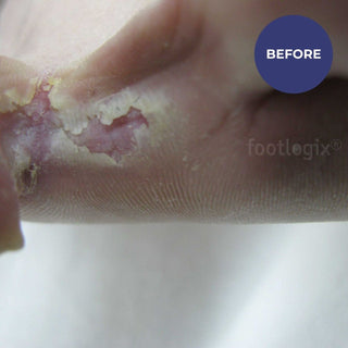 Footlogix Peeling Skin Formula (125ml)