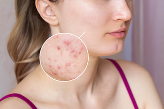 Acne & Scar Microneedling
