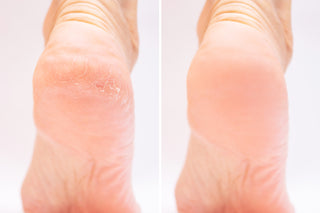 A pair of feet before and after a medical pedicure treatment, showing improvement in skin texture.