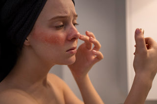 A person with redness on their face, possibly suffering from rosacea, applying a product to their skin.